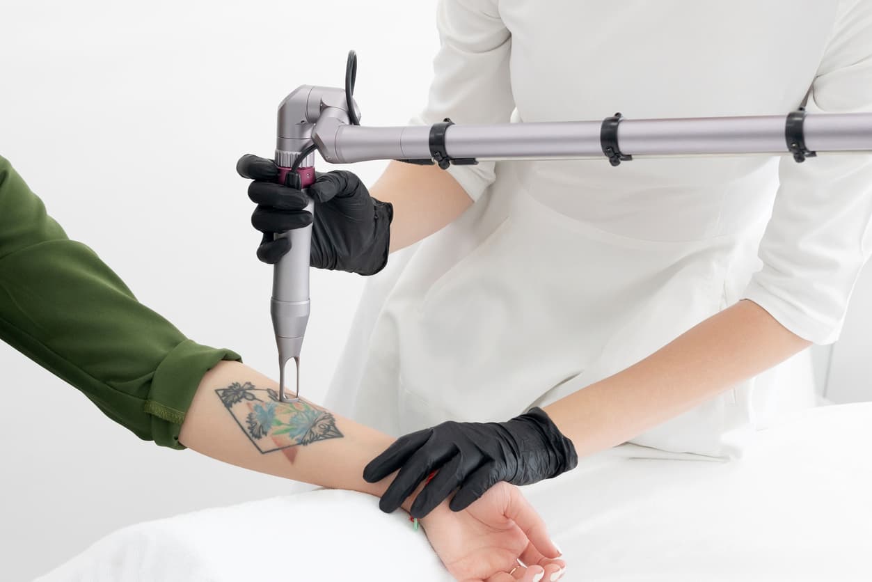 Laser Hair Removal