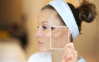 Defend Your Skin: A Comprehensive Guide to Melasma Prevention