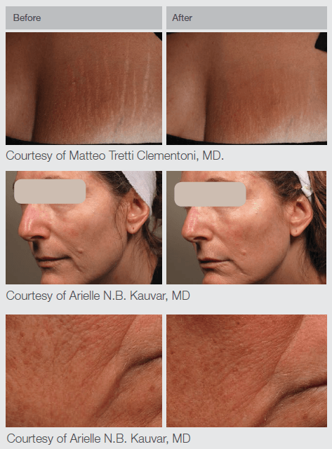 Laser Hair Removal