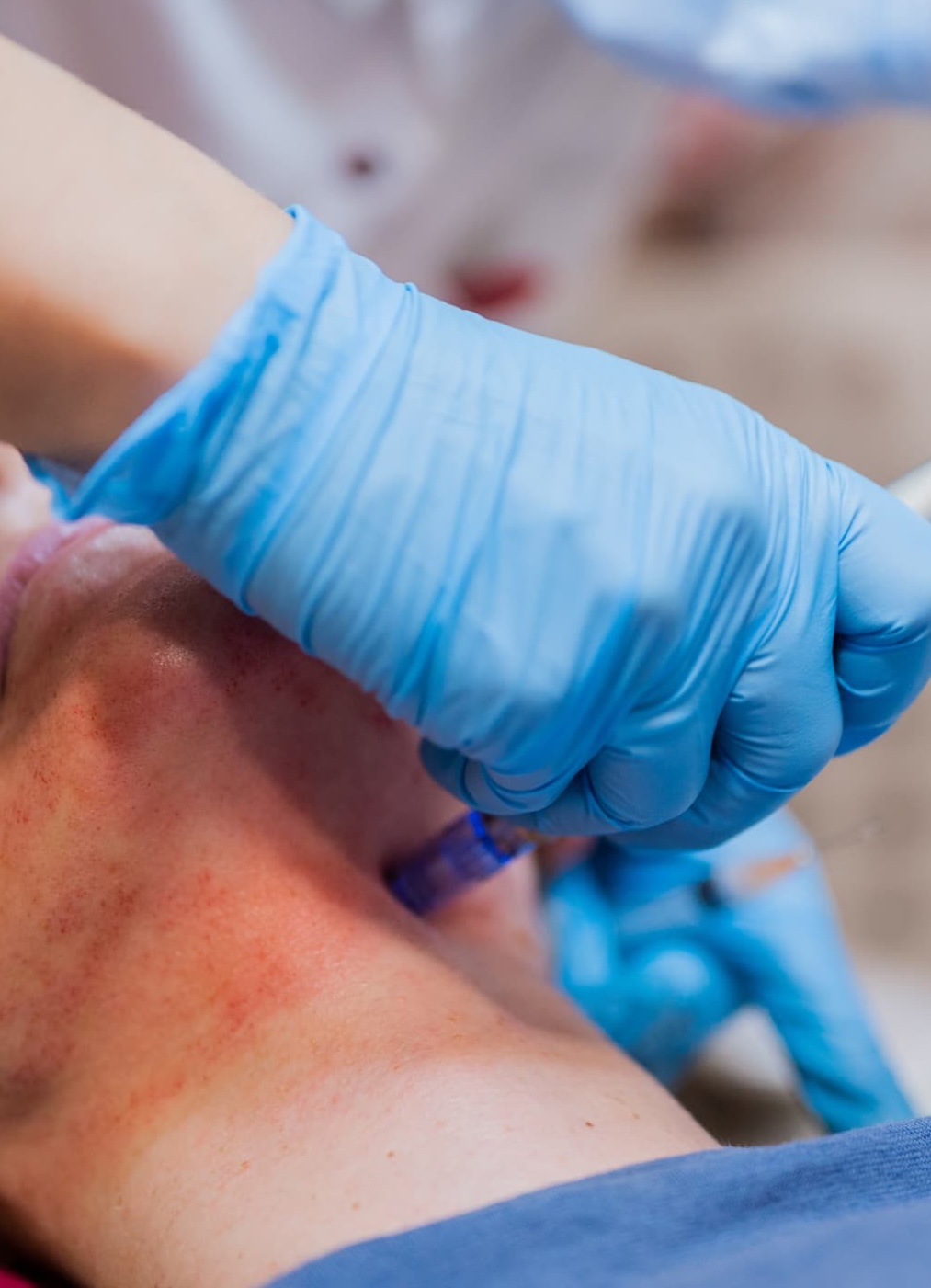 Laser Hair Removal