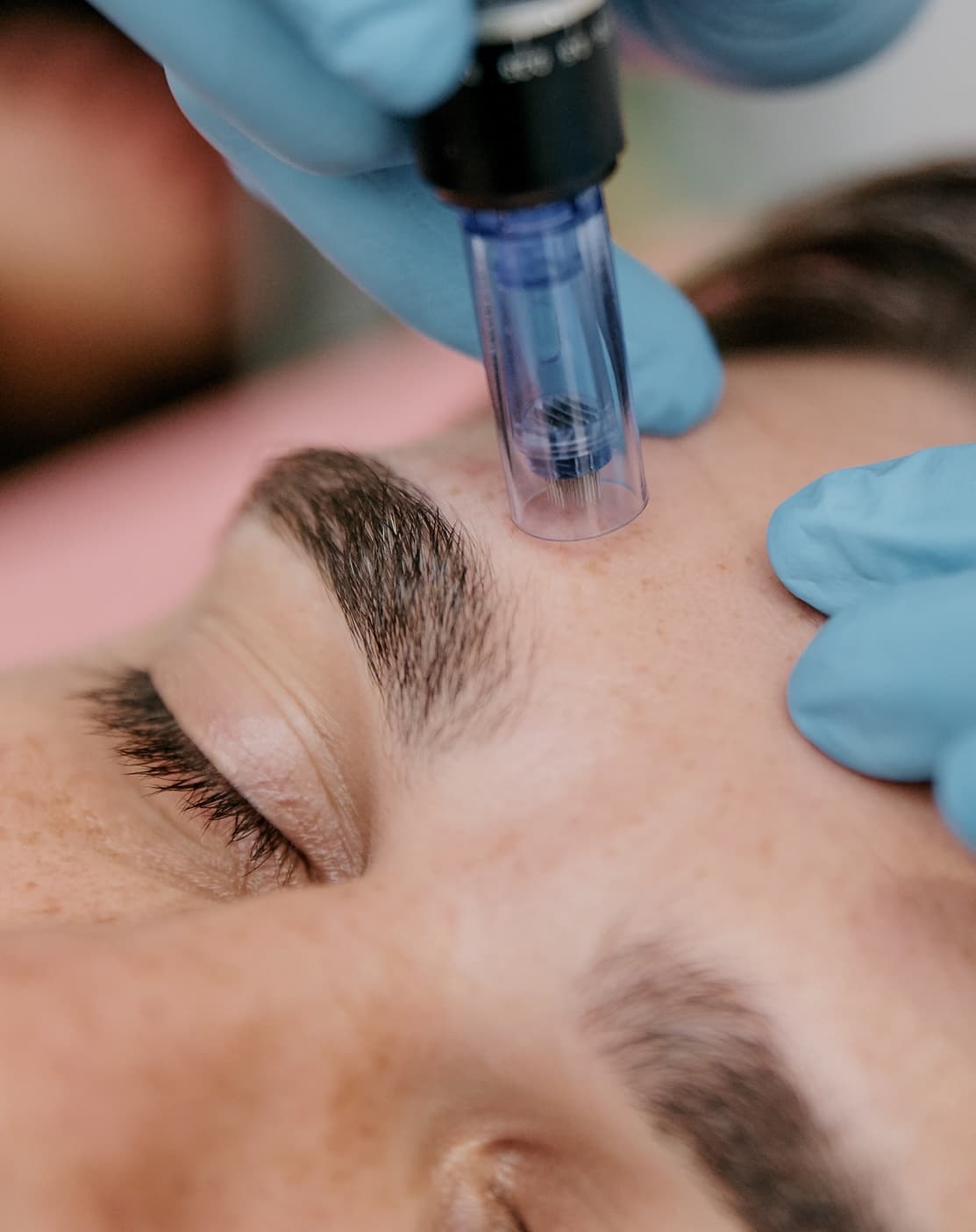 Laser Hair Removal